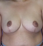 Breast Reduction (for Women)