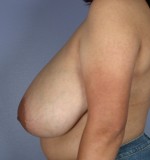 Breast Reduction (for Women) Before and after photo