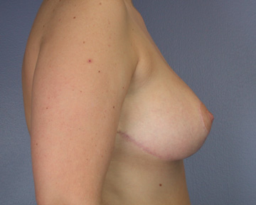 Breast Reduction (for Women) before and after photo