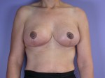 Breast Reduction (for Women)