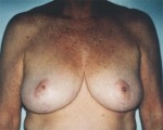 Breast Reduction (for Women)