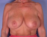 Breast Reduction (for Women)