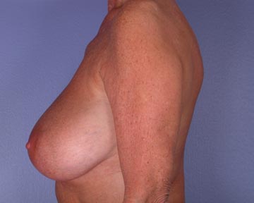 Breast Reduction (for Women) before and after photo