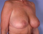 Breast Reduction (for Women) Before and after photo