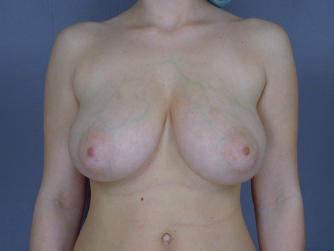 Breast Reduction (for Women) before and after photo