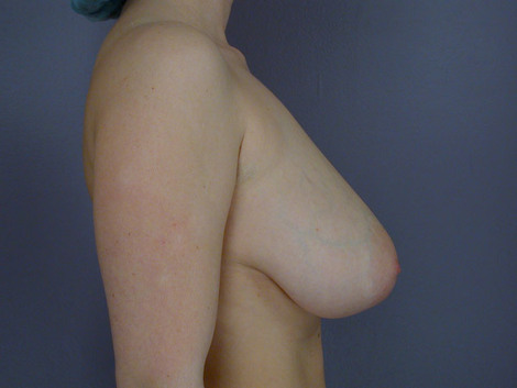 Breast Reduction (for Women) before and after photo