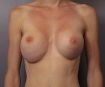 Breast Reduction (for Women)