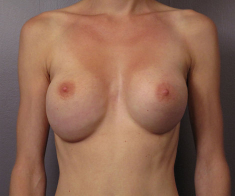 Breast Reduction (for Women) before and after photo