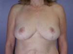 Breast Reduction (for Women)