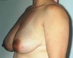 Breast Reduction (for Women)