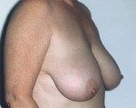 Breast Reduction (for Women)