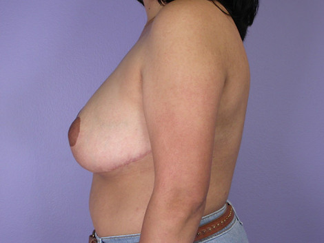 Breast Reduction (for Women) before and after photo