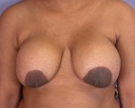 Breast Reduction (for Women)