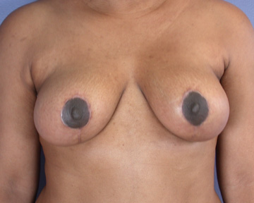 Breast Reduction (for Women) before and after photo