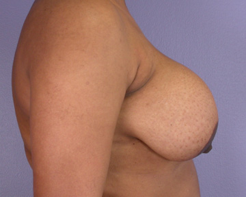 Breast Reduction (for Women) before and after photo