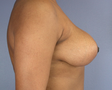 Breast Reduction (for Women) before and after photo