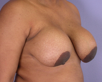 Breast Reduction (for Women) before and after photo