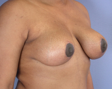 Breast Reduction (for Women) before and after photo