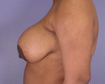 Breast Reduction (for Women) before and after photo