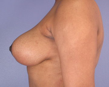 Breast Reduction (for Women) before and after photo