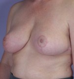 Breast Reduction (for Women) Before and after photo