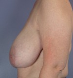 Breast Reduction (for Women) Before and after photo