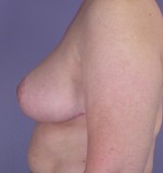 Breast Reduction (for Women) Before and after photo