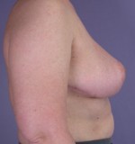 Breast Reduction (for Women) Before and after photo