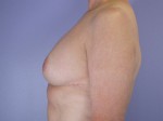 Breast Reduction (for Women) Before and after photo