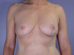 Breast Reduction (for Women) Before and after photo