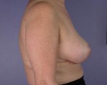 Breast Reduction (for Women)