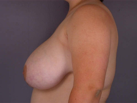 Breast Reduction (for Women) before and after photo