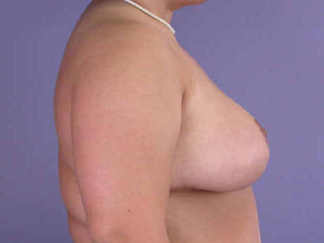 Breast Reduction (for Women) before and after photo