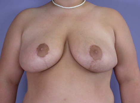 Breast Reduction (for Women) before and after photo