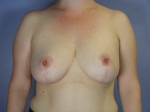 Breast Reduction (for Women)