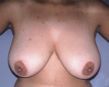 Breast Reduction (for Women) before and after photo