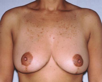 Breast Reduction (for Women) before and after photo