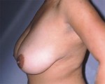 Breast Reduction (for Women) Before and after photo