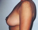 Breast Reduction (for Women)