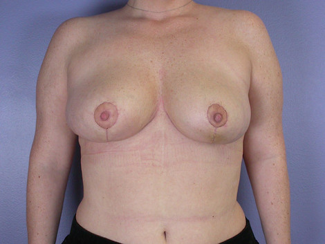 Breast Reduction (for Women) before and after photo