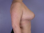 Breast Reduction (for Women) Before and after photo