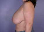 Breast Reduction (for Women) Before and after photo