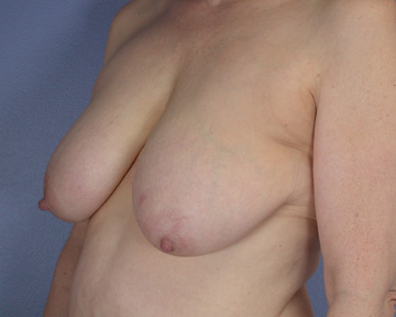 Breast Reduction (for Women) before and after photo