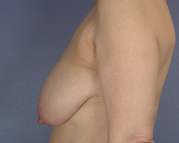 Breast Reduction (for Women) before and after photo