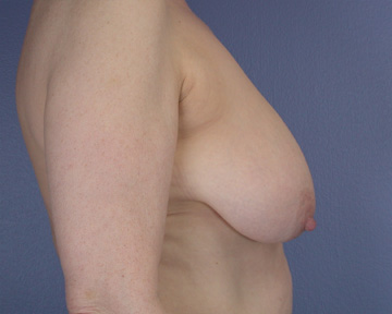 Breast Reduction (for Women) before and after photo