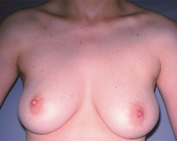 Breast Reduction (for Women) before and after photo