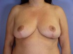 Breast Reduction (for Women) Before and after photo