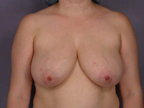 Breast Reduction (for Women) before and after photo