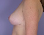 Breast Reduction (for Women) Before and after photo