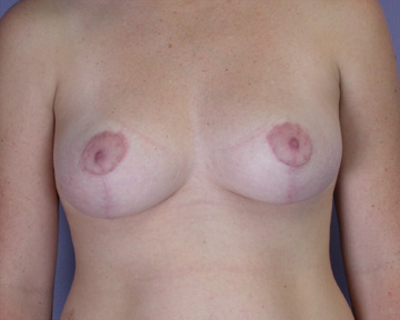 Breast Reduction (for Women) before and after photo